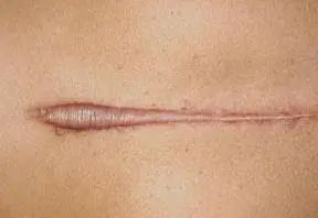 Remedies For Keloid Scarring | Homeopathy Plus