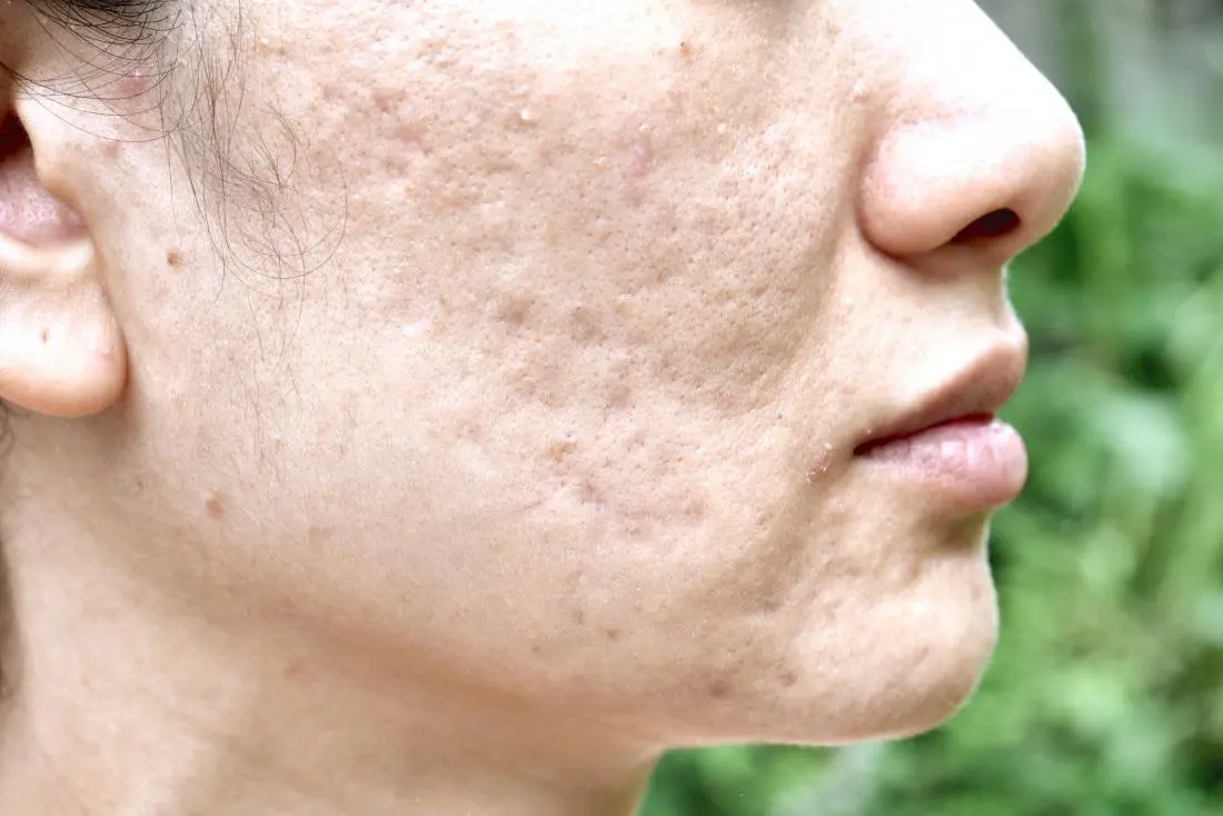 How to get rid of acne scars: Treatments and home remedies