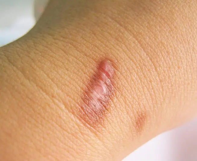 What is a Hypertrophic Scar? - Scarfade