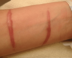 Hypertrophic scar formation on the wrist