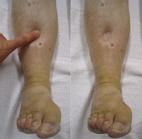 Pitting and swelling in the legs in people with lymphedema