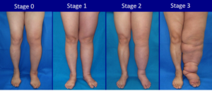 The 4 stages of leg swelling in lymphedema