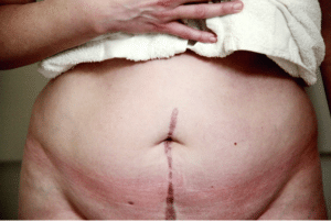 Abdominal scar after surgery