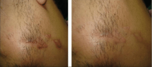 Hypertrophic-scar-before-and-after-silicone-gel